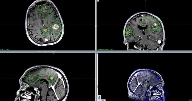 patient brain scans